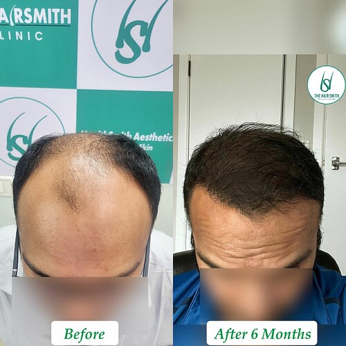 Best Hair Transplant Result with The Hairsmith Clinic Laxmi Nagar