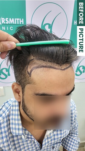 Before Picture patient from The Hairsmith Clinie - We Care For Your Hair (C)