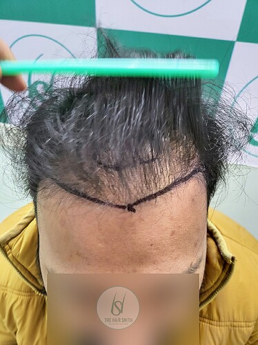 Before After comparison hair transplant result from The Hairsmith Clinic - Hair Transplant Clinic (A)