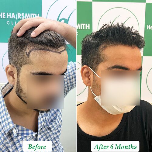 Best Hair Transplant Result  at The Hairsmith Clinic - Most Natural Hair Transplant Centre B