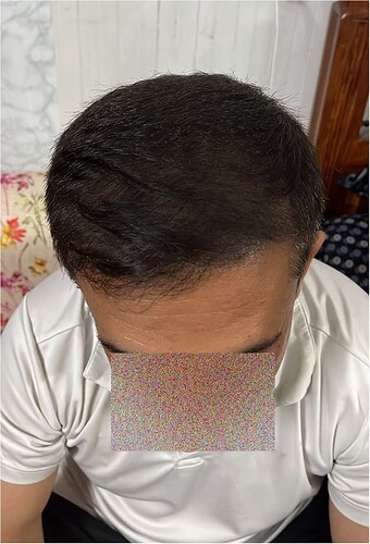 After 7 Months Hair Transplant Picture (3)  The Hairsmith Clinic - We Care For Your Hair