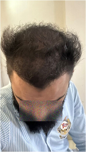 After Hair Transplant Patient Picture (B) at The Hairsmith Clinic