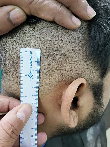 Before After comparison hair transplant result from The Hairsmith Clinic - Hair Transplant Clinic (F)