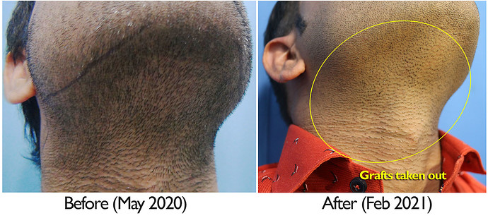 A229 - Hair Transplant Result - DrAsClinic (5)