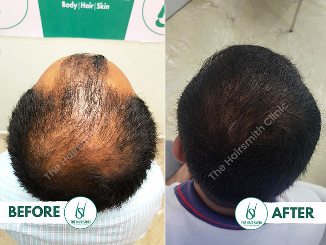 Best Hair Transplant Result - Before and After - The Hairsmith Hair Transplant  Clinic - B