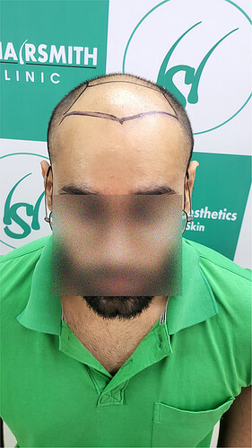 Patient Before Hair Loss Picture 1 at The Hairsmith Clinic - We Care For Your Hair