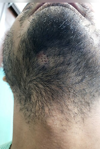 Beard Grafts Extraction Picture from The Hairsmith Clinic - We Care For Your Hair