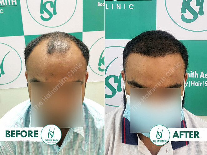 Best Hair Transplant Result - Before and After - The Hairsmith Hair Transplant  Clinic - A