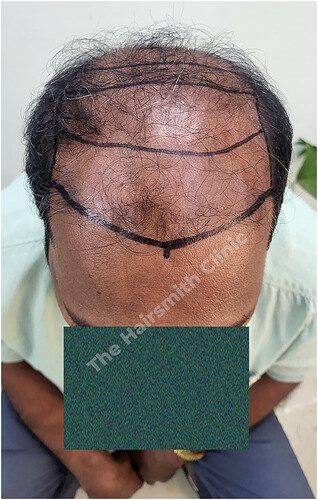 Patient Norwood stages 8 Before  Picture 4 at The Hairsmith Hair Transplant Clinic