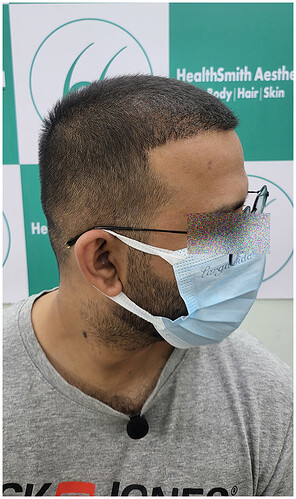 After 6 Months Hair Transplant Picture (2)  The Hairsmith Clinic - We Care For Your Hair