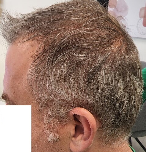 9. Result of Connection of top hair with donor - Left