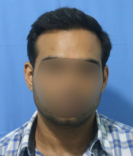 Hair%20Transplant%20Result%20-%20After%20picture%20-%20A215%20-%20drasclinic%20(1)