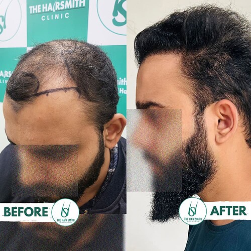 Best Hair Transplant Clinic in Delhi - Best Hair Transplant clinic in India - Best Hair Transplant Doctor in Delhi - Best Hair Transplant Doctoe in India - The Hairsmith Clinic - 3