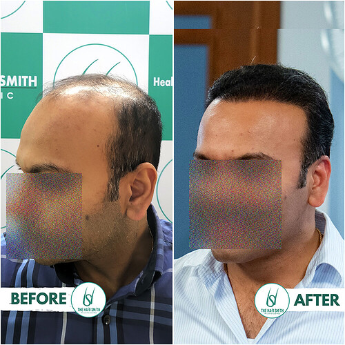 Best Hair Transplant  Result in India  form The Hairsmith Clinic Faceblur  AAA.PNG