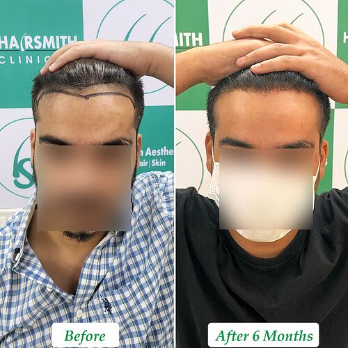 Best Hair Transplant Result  at The Hairsmith Clinic - Most Natural Hair Transplant Centre (A)