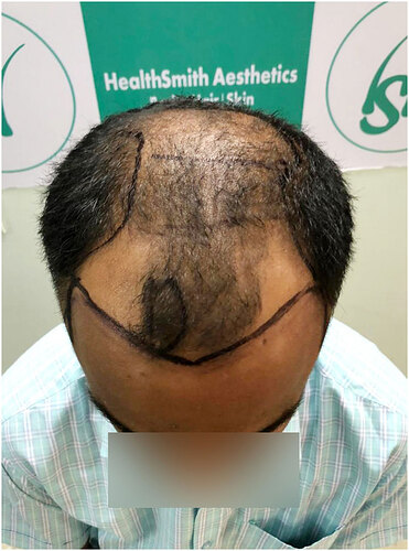 Patient Before Hair Loss Picture 2 at The Hairsmith Hair Transplant Clinic