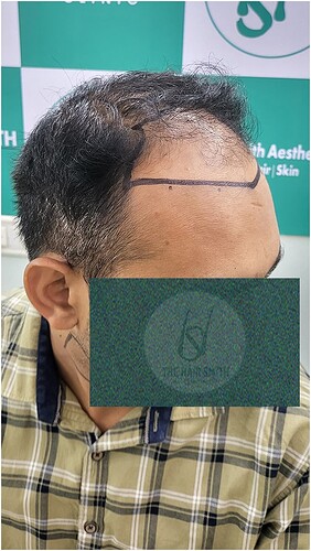 Patient Norwood stages 5 - Before  Picture 3 - The Hairsmith Hair Transplant Clinic