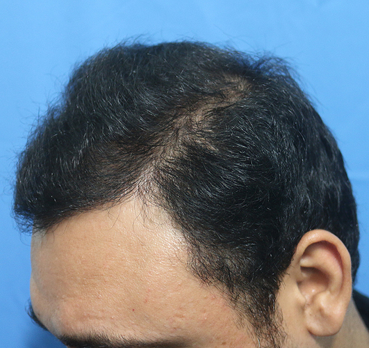 Hair%20Transplant%20Result%20-After%20picture%20-%20A216%20-%20drasclinic%20(2)