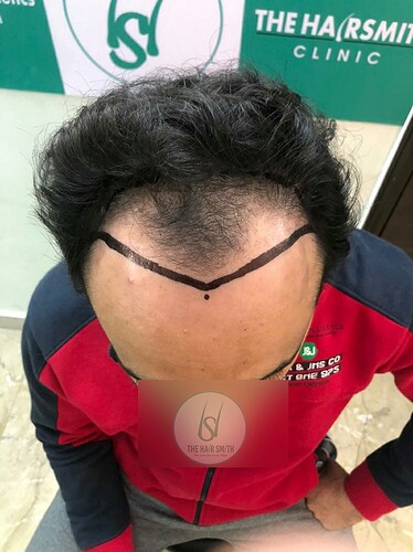 Patient Before Picture (C)  from The Hairsmith - Best Hair Transplant Centre
