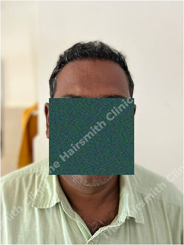 After Hair Transplant Result 1 in India  form The Hairsmith Clinic