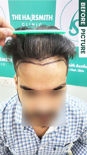 Before Picture patient from The Hairsmith Clinie - We Care For Your Hair (B)