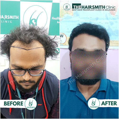 Best Hairline Hair Transplant Result 2 in India  form The Hairsmith Clinic Laxmi Nagar