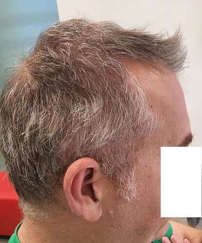 10. Result of Connection of top hair with donor - Right