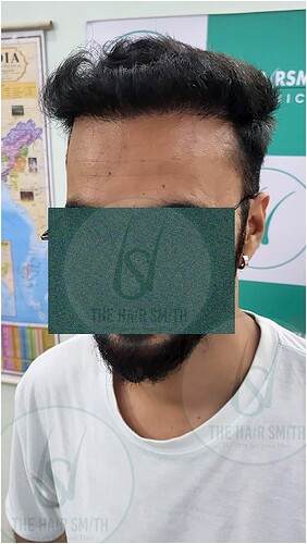 After Hairline Hair Transplant Result 4 in India  form The Hairsmith Clinic