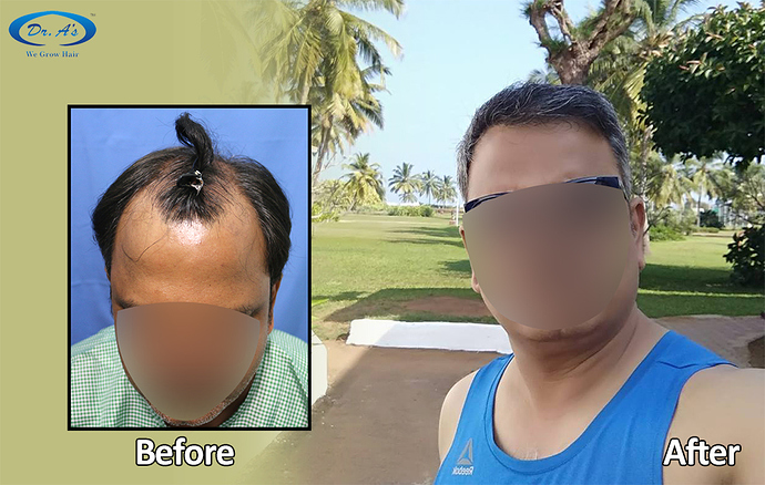 Hair%20Transplant%20Result%20-%20A218%20-%20drasclinic%20(2)