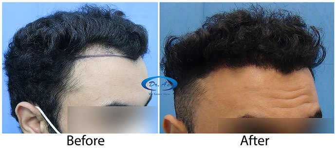 Hair-Transplant-Result(2)-DrAsClinic