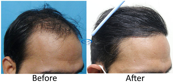 A228 - Hair Transplant Result - DrAsClinic (2)