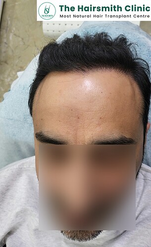 After 12 Months Hair Transplant Results (A)  from The Hairsmith Clinic