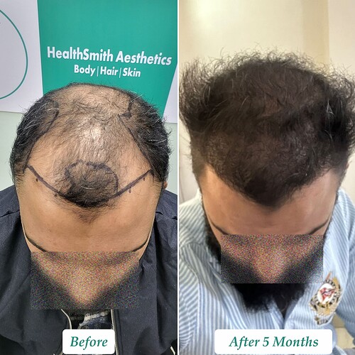 Hair Transplant Result (B) at The Hairsmith Clinic in India