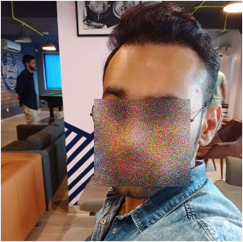 After 9 Months Hair Transplant Result  - The Hairsmith Clinic - We Care For Your Hair