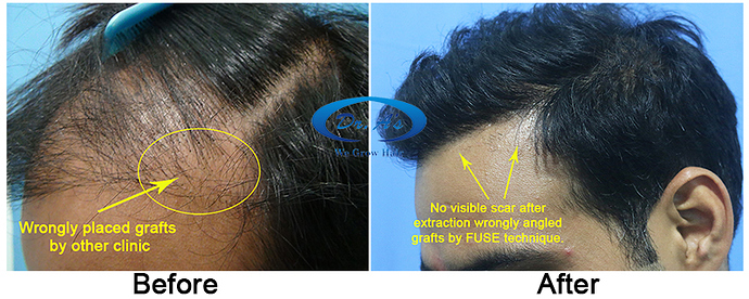 Hair%20Transplant%20Result%20-%20%20Comparison%20pictures%20-%20A215%20-%20drasclinic%20(1)