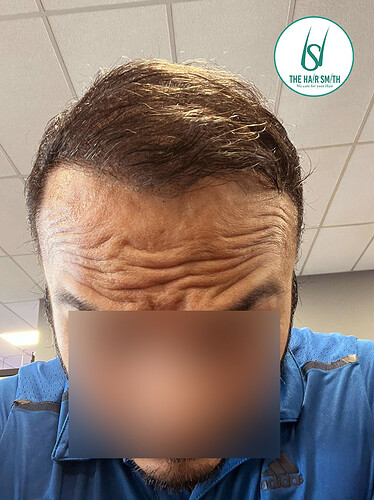 After Hair Transplant Picture (B) form The Hairsmith Clinic - We Care For Your Hair