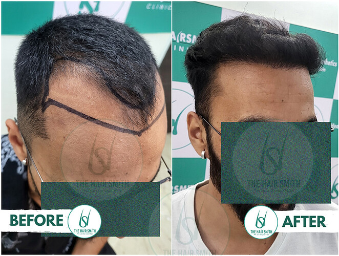 Best Hairline Hair Transplant Result Picture C - The Hairsmith Clinic