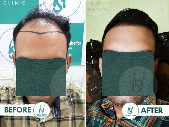 Hairline Hair Transplant Result After 1 Years Update - The Hairsmith Hair Transplant Clinic