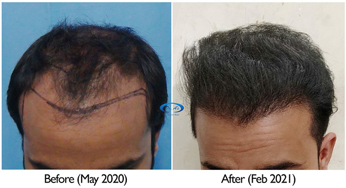 A229 - Hair Transplant Result - DrAsClinic (3)