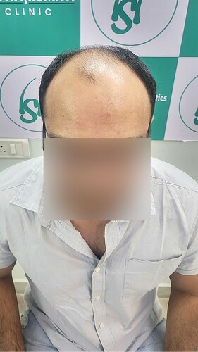 Patient Before Picture (A) form The Hairsmith Clinic - We Care For Your Hair