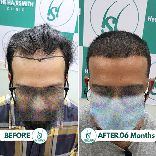 Hair Transplant Result (2)  After 06 Months from The Hairsmith Clinic