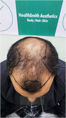 Patient Before Hair Loss Picture (D) at The Hairsmith Clinic