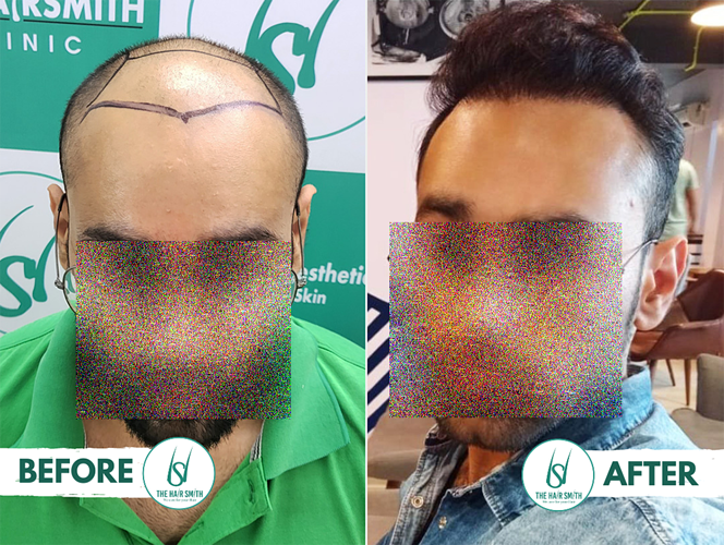 Best Hair Transplant Result - Before After - The Hairsmith Clinic - We Care For Your Hair