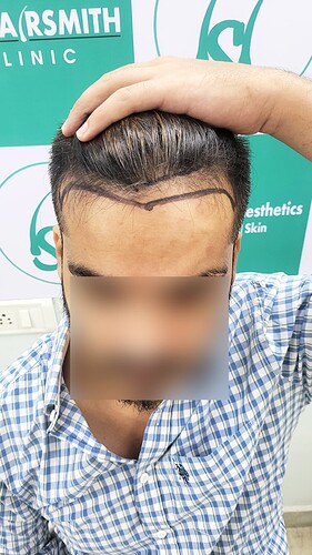 Before Picture patient from The Hairsmith Clinie - We Care For Your Hair (A)