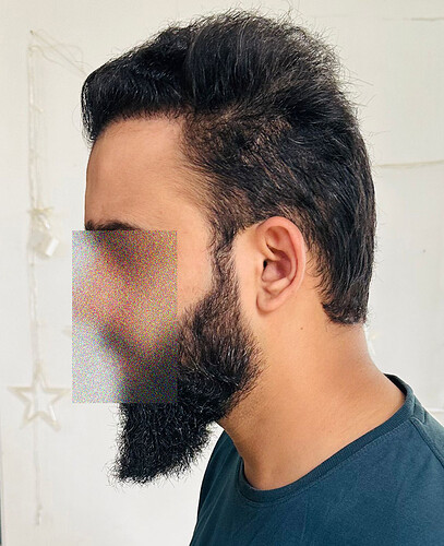After 8 Months  Hair Transplant Result  (C) at The Hairsmith Clinic - We Care For Your Hair