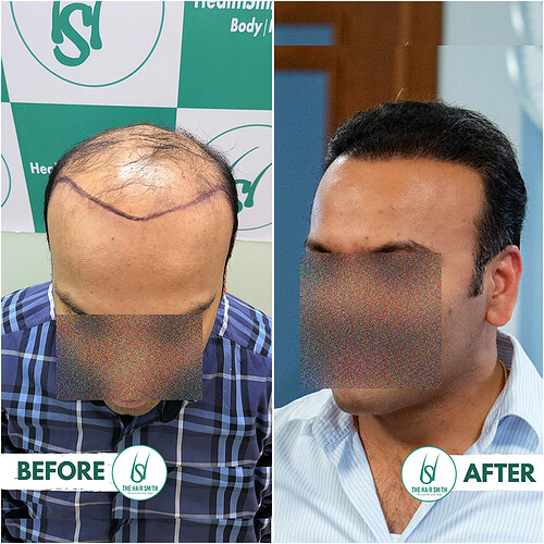 Best Hair Transplant  Result in India  form The Hairsmith Clinic Faceblur  AA.PNG