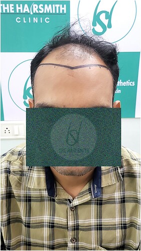Patient Norwood stages 5 - Before  Picture 1 - The Hairsmith Hair Transplant Clinic