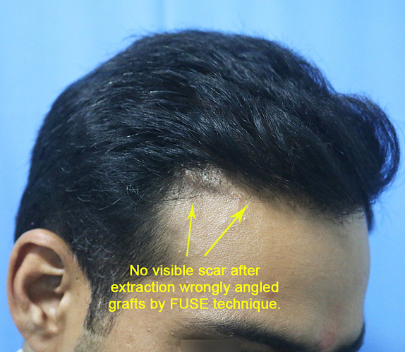 Hair%20Transplant%20Result%20-%20After%20picture%20-%20A215%20-%20drasclinic%20(2)