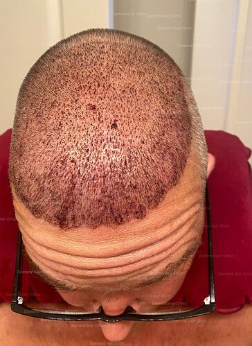 hair transplant in turkey - Dr. Mehmet Demircioglu - Diamond Hair Clinic - Patient Jason - 6
