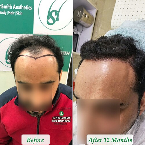 Before After comparison hair transplant result from The Hairsmith Clinic - Hair Transplant Clinic (B)
